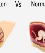 Why You Should Never Opt For A C-Section (And The Dangers Of Having One)