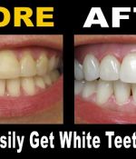 How To Easily Get White Teeth Naturally