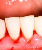 Why Your Teeth Could Start Bleeding Uncontrollably at Any Time (And How To Control It)