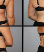 4 Simple Exercises to Get Your Back Bikini Ready