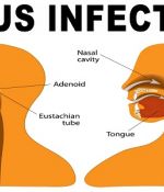 4 Home Remedies to Quickly Get Rid of Sinus Infections