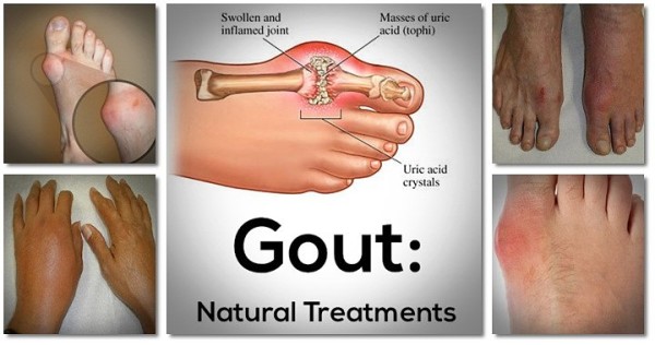 say-goodbye-to-gout-forever-with-this-powerful-natural-treatment-1